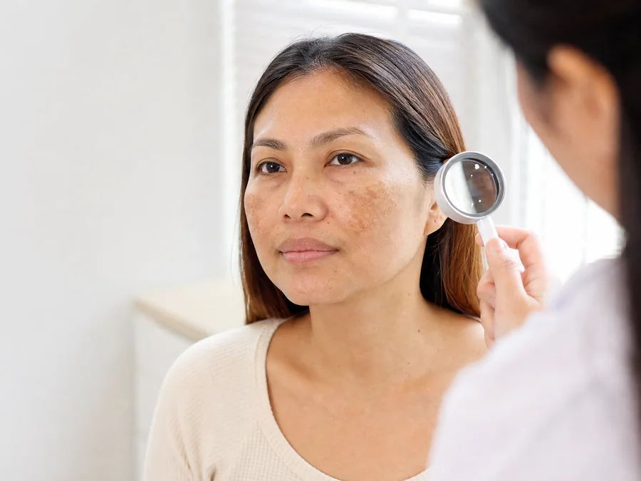 A woman with patches of pigmentation on her cheeks in a bright consultation room